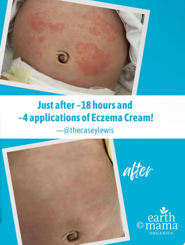 Eczema Cream | Earth Mama